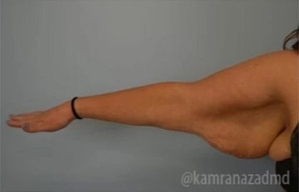 Arm Lift Before & After Patient #1489