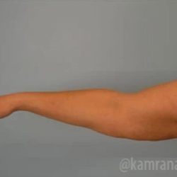 Arm Lift Before & After Patient #1489