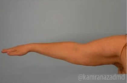 Arm Lift Before & After Patient #1489