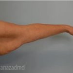Arm Lift Before & After Patient #1489