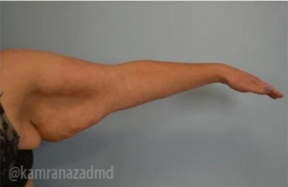 Arm Lift Before & After Patient #1489