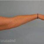 Arm Lift Before & After Patient #1489