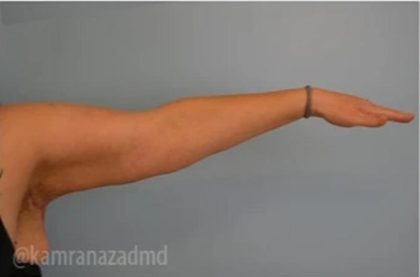 Arm Lift Before & After Patient #1489