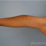Arm Lift Before & After Patient #1490
