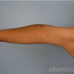 Arm Lift Before & After Patient #1490
