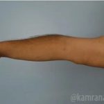 Arm Lift Before & After Patient #1490