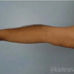 Arm Lift Before & After Patient #1490