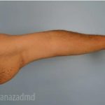 Arm Lift Before & After Patient #1490