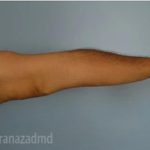 Arm Lift Before & After Patient #1490