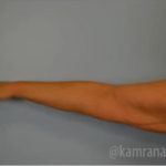 Arm Lift Before & After Patient #1492