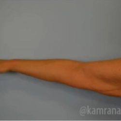 Arm Lift Before & After Patient #1492