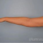Arm Lift Before & After Patient #1492