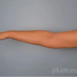 Arm Lift Before & After Patient #1492