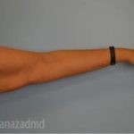 Arm Lift Before & After Patient #1492