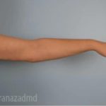 Arm Lift Before & After Patient #1492
