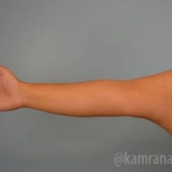 Arm Lift Before & After Patient #1494