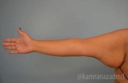Arm Lift Before & After Patient #1494