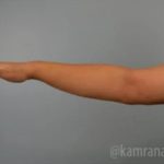 Arm Lift Before & After Patient #1494
