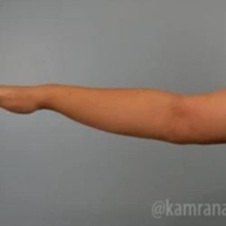 Arm Lift Before & After Patient #1494