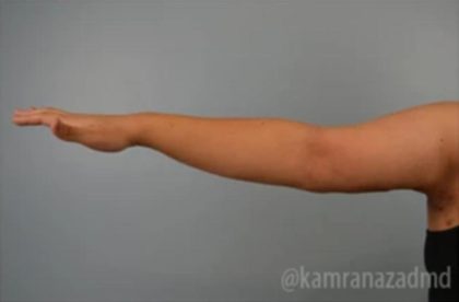Arm Lift Before & After Patient #1494