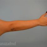 Arm Lift Before & After Patient #1494