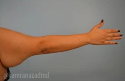 Arm Lift Before & After Patient #1494