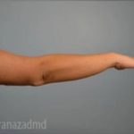 Arm Lift Before & After Patient #1494