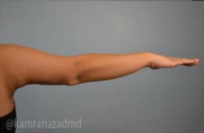 Arm Lift Before & After Patient #1494