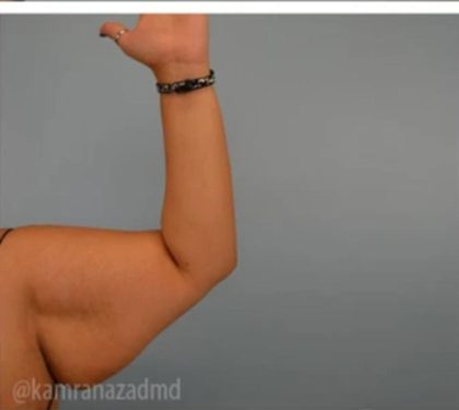 Arm Lift Before & After Patient #1494