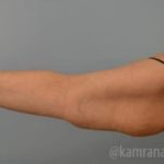 Arm Lift Before & After Patient #1496