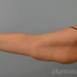 Arm Lift Before & After Patient #1496