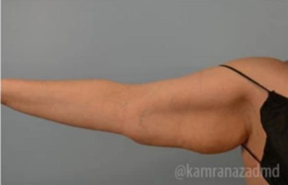 Arm Lift Before & After Patient #1496