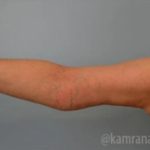 Arm Lift Before & After Patient #1496