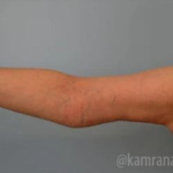 Arm Lift Before & After Patient #1496