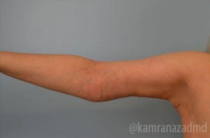 Arm Lift Before & After Patient #1496