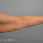 Arm Lift Before & After Patient #1496