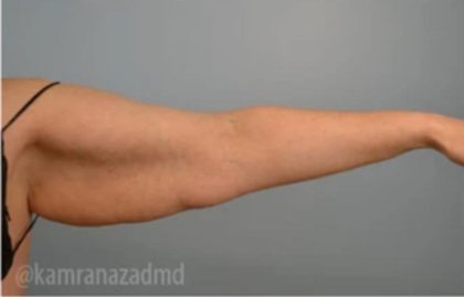 Arm Lift Before & After Patient #1496