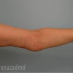 Arm Lift Before & After Patient #1496