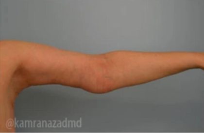 Arm Lift Before & After Patient #1496