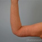 Arm Lift Before & After Patient #1496