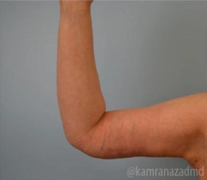 Arm Lift Before & After Patient #1496