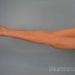 Arm Lift Before & After Patient #1498