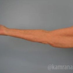 Arm Lift Before & After Patient #1498