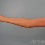 Arm Lift Before & After Patient #1498