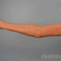 Arm Lift Before & After Patient #1498