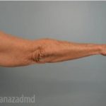Arm Lift Before & After Patient #1498
