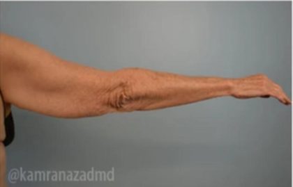 Arm Lift Before & After Patient #1498