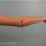 Arm Lift Before & After Patient #1498