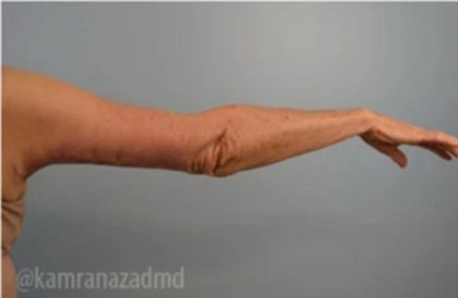 Arm Lift Before & After Patient #1498