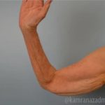Arm Lift Before & After Patient #1498